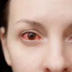 Penyakit Mata Merah
