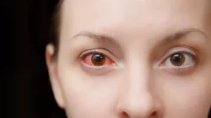 Penyakit Mata Merah